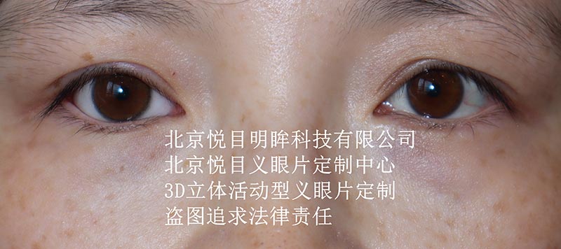 3D立体活动型义眼片定制效果