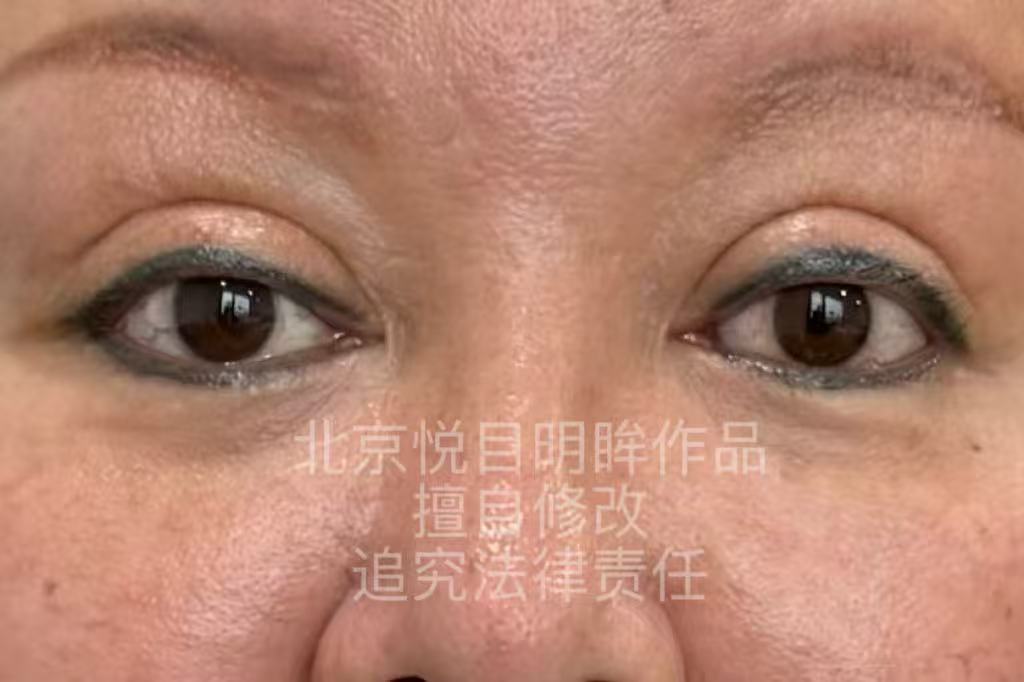 做义眼，不是让你回到过去，